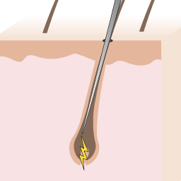 Mishael's Electrolysis Center for Eletrolysis Hair Removal